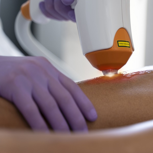 depilacion laser diodo en pozuelo de alarcon y aravaca precio