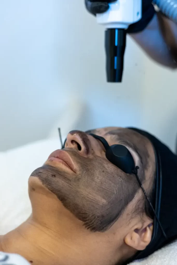 peeling facial en pozuelo de alarcon y aravaca precio